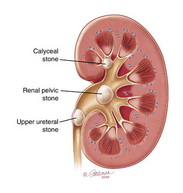 kidney stones removal report review